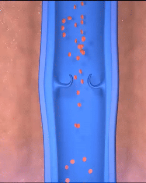 Animation: gestaute Flüssigkeit im Lymphgefäß