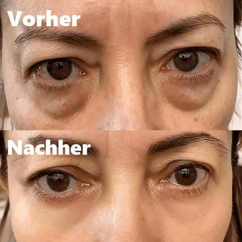 Augenpartie vorher und nachher