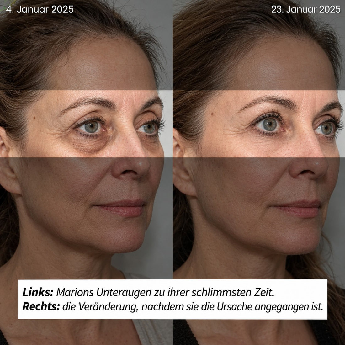 Marions Unteraugen vorher und nachher