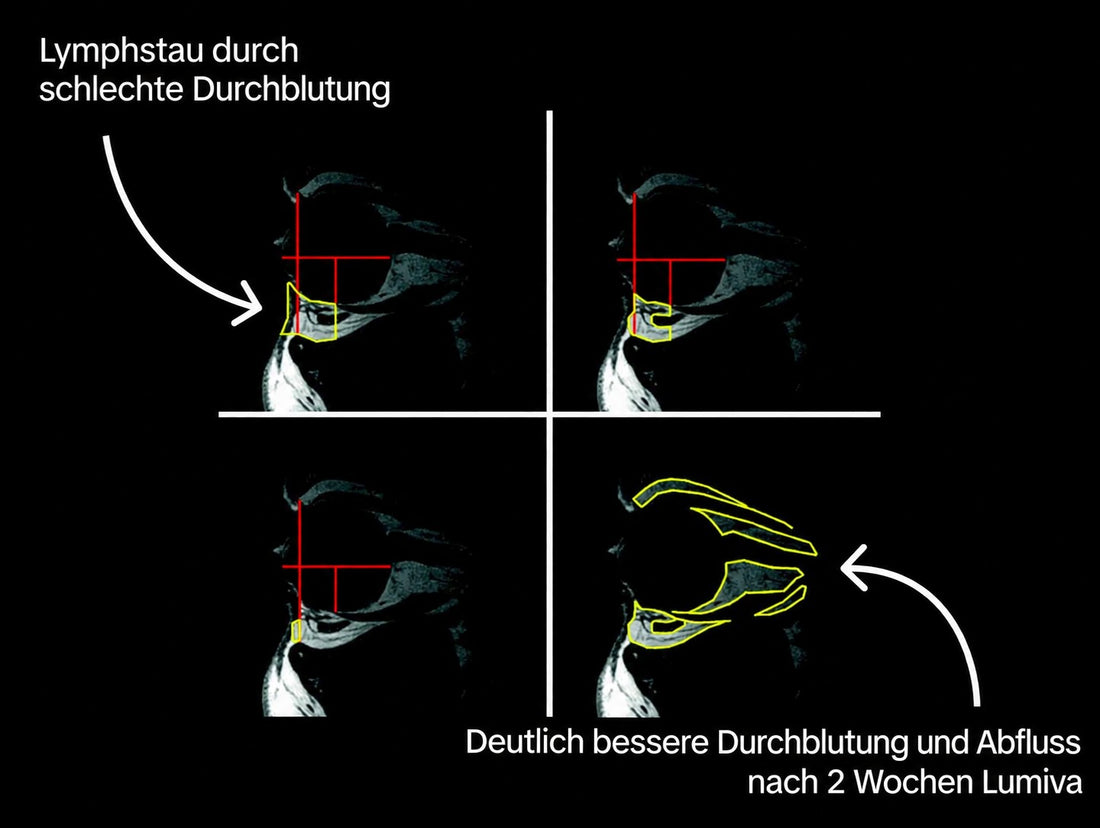 Lymphstau und besserer Abfluss nach 2 Wochen Lumiva